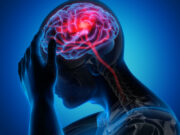 BEFAST: A Vital Response Program for Managing Stroke