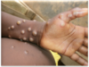 Second Mpox case detected- GHS Confirms Ghana has confirmed a second case of Mpox, bringing the total number of infections to two.