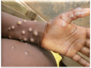 Second Mpox case detected- GHS Confirms Ghana has confirmed a second case of Mpox, bringing the total number of infections to two.