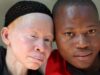 Free cancer screening and sunscreen needed for persons with albinism – Ablekuma North MP free sun screening for persons living with albinism