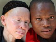 International Albinism Awareness Day: Understanding the genetic condition and breaking the stigma free sun screening for persons living with albinism