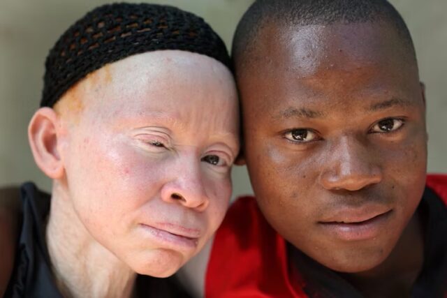 international albinism day_ free sun screening for persons living with albinism